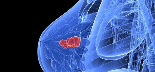 Rakovina prsu/ilustrační foto