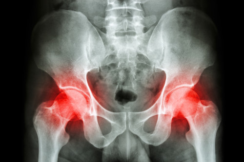 Osteoporóza/ilustrační foto